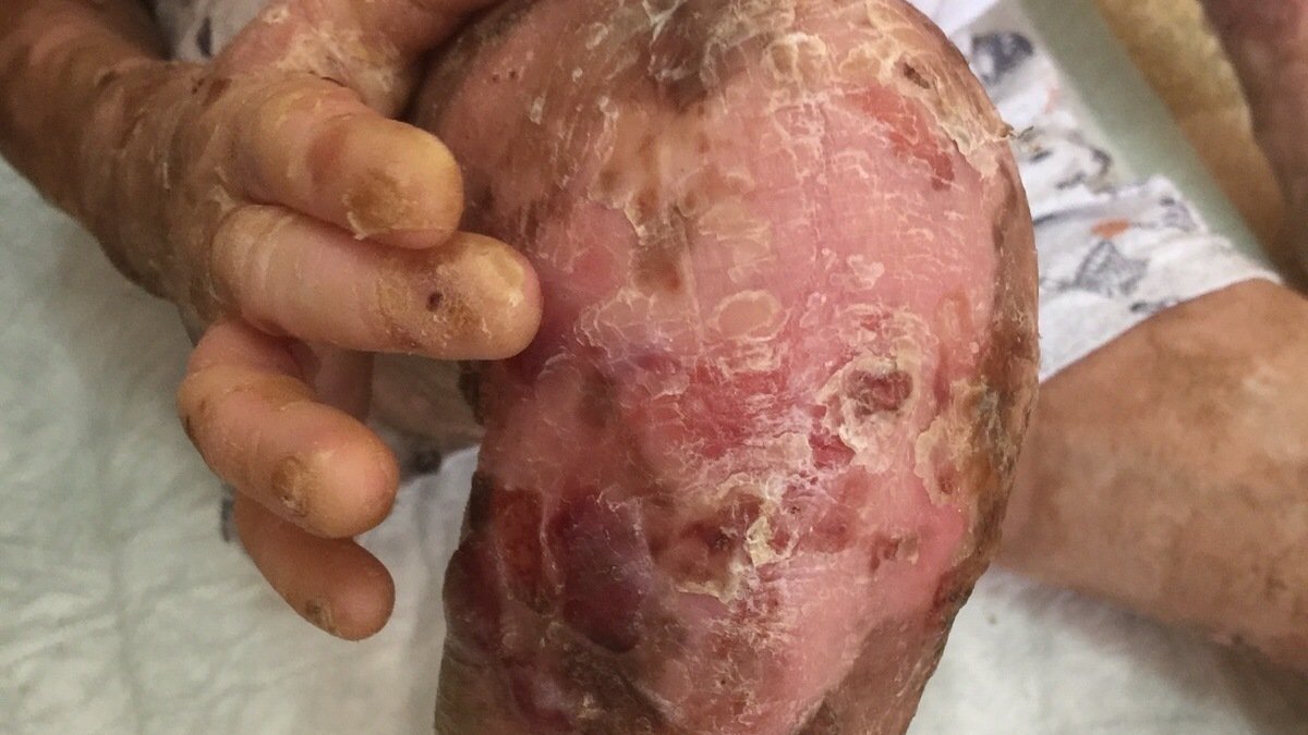 Kelebek hastalığı nedir, neden olur, nasıl olur? Kelebek hastalığı bulaşıcı mı, geçer mi?