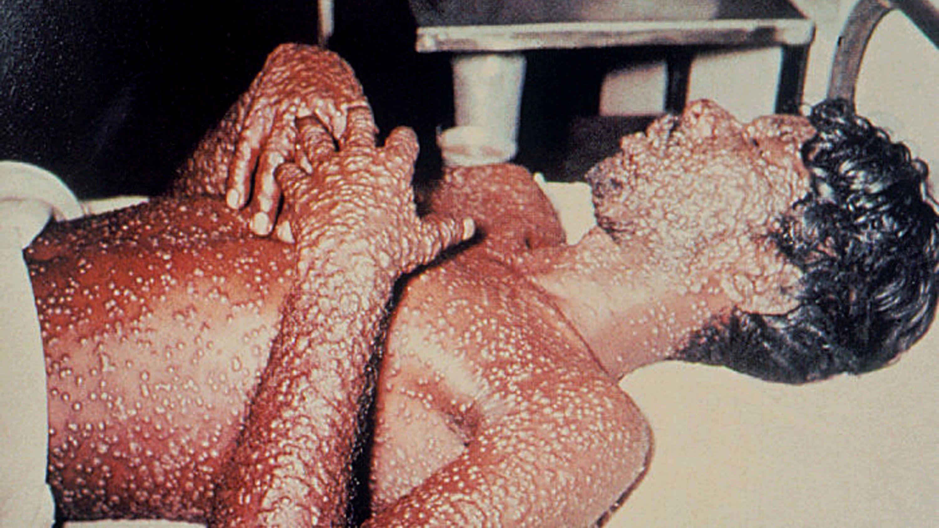 Çiçek hastalığı nedir? Neden olur? Belirtileri nelerdir? Tedavisi var mı?