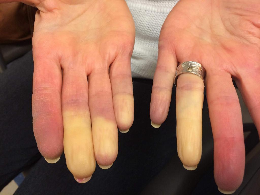 Raynaud hastalığı nedir? Belirtileri nelerdir? Tanısı nasıl konulur? Nasıl tedavi edilir? 