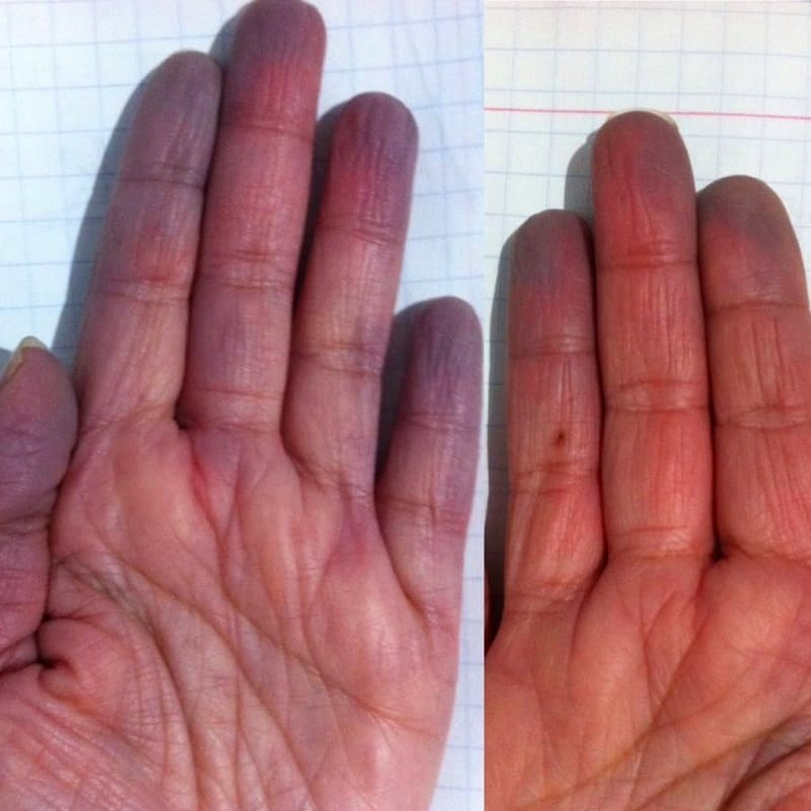 Raynaud hastalığı nedir? Belirtileri nelerdir? Tanısı nasıl konulur? Nasıl tedavi edilir? 