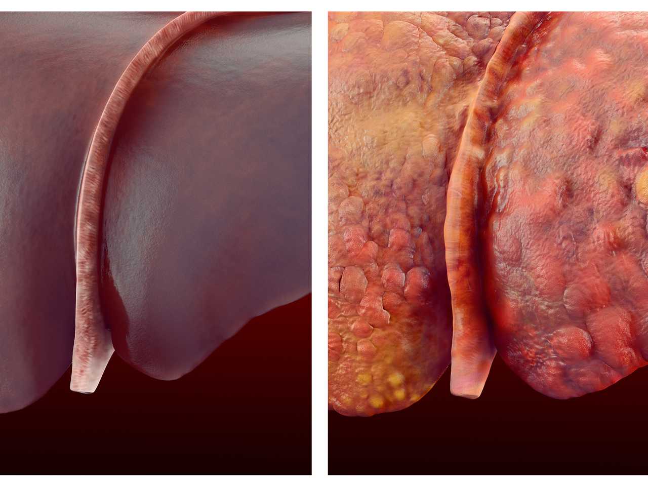 Siroz hastalığı nedir? Neden olur? Belirtileri nelerdir? Bulaşıcı mıdır? Tedavisi var mı?