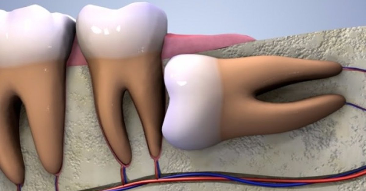 20'lik diş ağrısı nedir, nasıl olur, nereye vurur? 20'lik diş ağrısı kaç gün sürer, nasıl geçer, ne iyi gelir?
