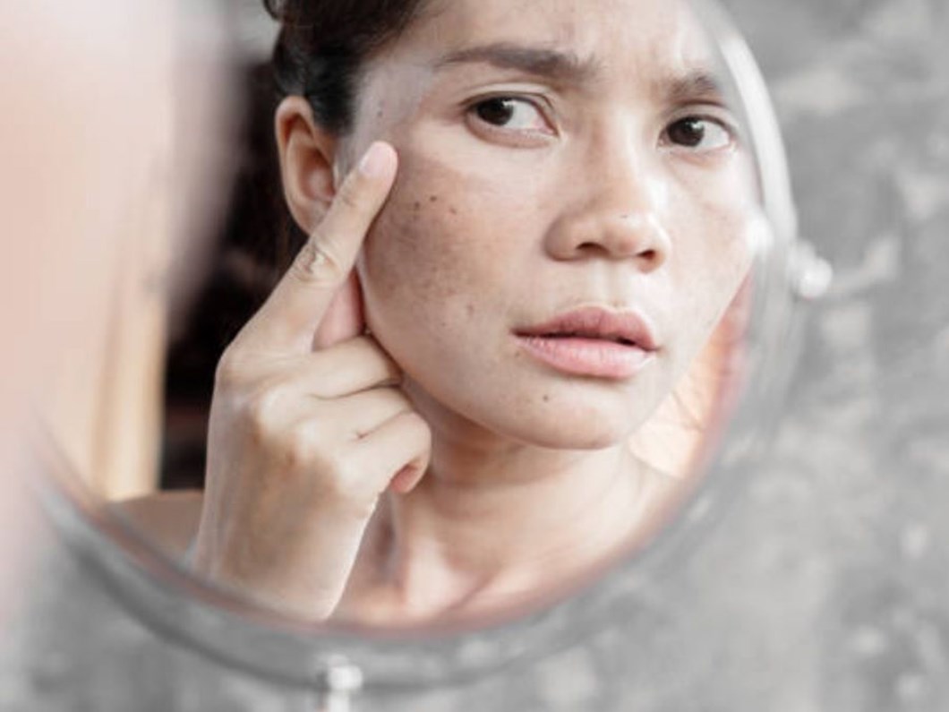 Güneş lekeleri nasıl geçer, neden olur, nasıl giderilir, nasıl çıkar? Güneş lekelerine ne iyi gelir, krem, maske, sabun