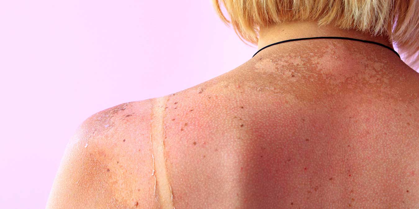 Güneş lekeleri nasıl geçer, neden olur, nasıl giderilir, nasıl çıkar? Güneş lekelerine ne iyi gelir, krem, maske, sabun