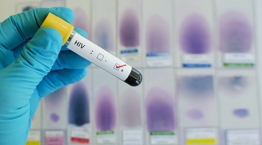 AIDS nedir? Belirtileri nedir, nasıl bulaşır ? Tedavi yöntemleri ve korunma yolları nelerdir?