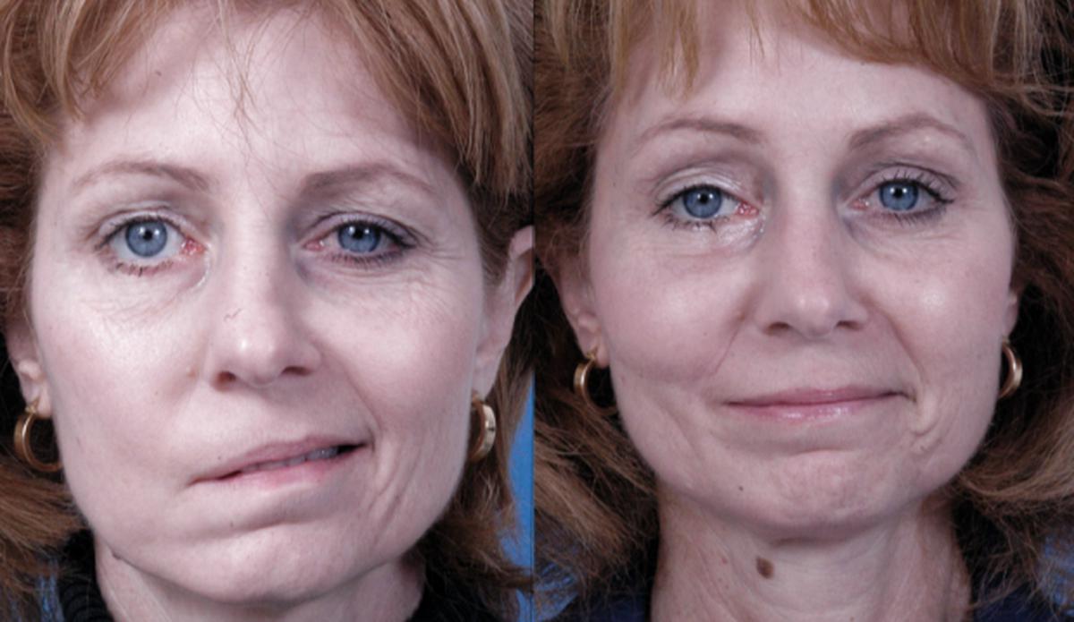 Yüz felci nedir? Neden olur? Kaç günde geçer? | Yüz felci belirtileri, tedavisi, duası 