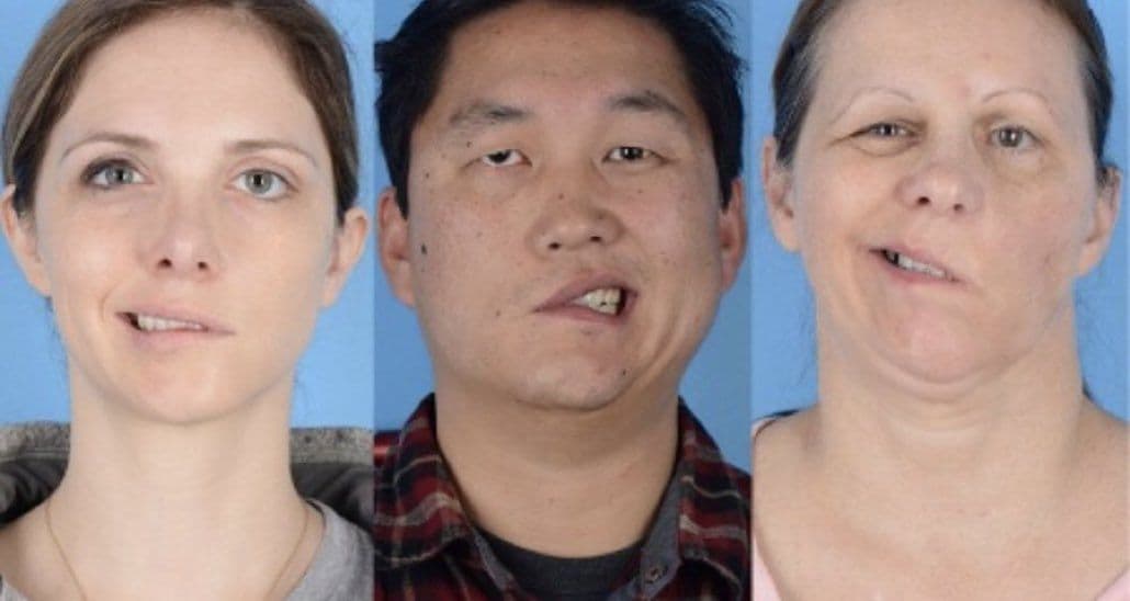 Yüz felci nedir? Neden olur? Kaç günde geçer? | Yüz felci belirtileri, tedavisi, duası 