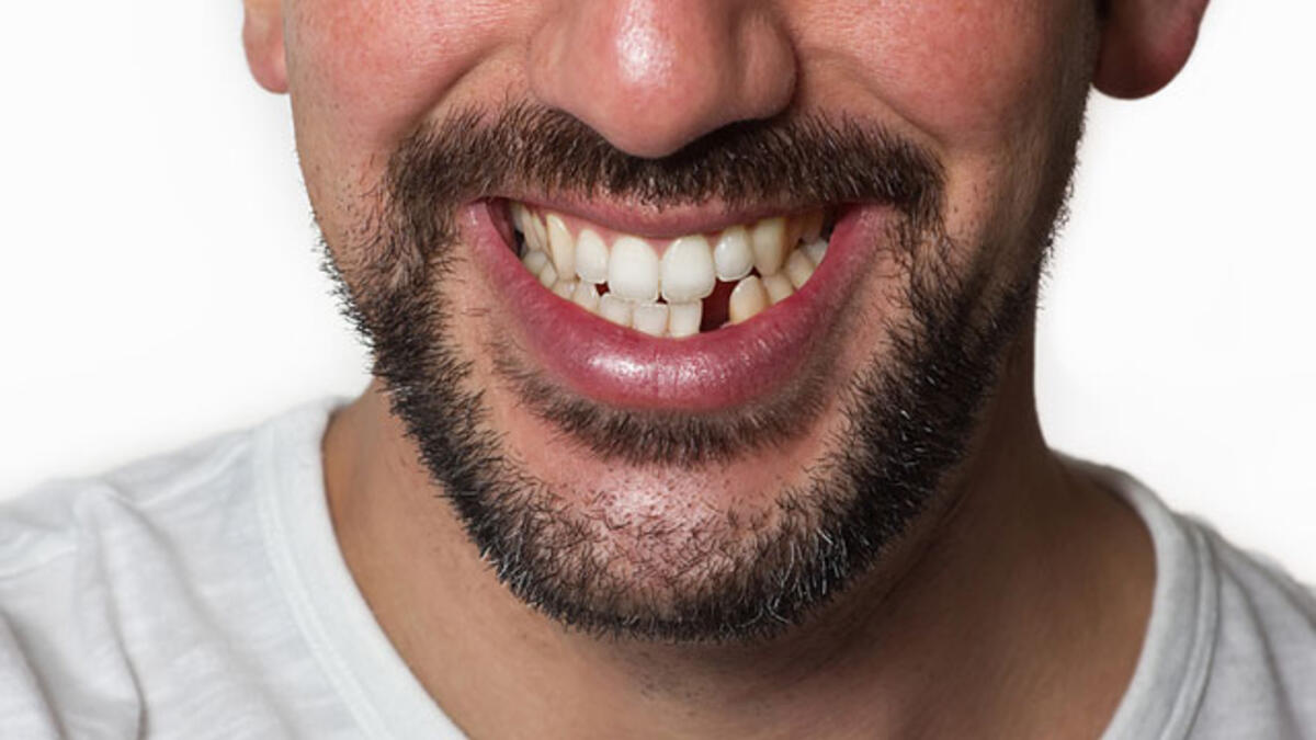 Rüyada Dişin Düşmesi / Rüyada Dişlerin Düşmesi / Rüyada Diş Düşürmek Tabiri