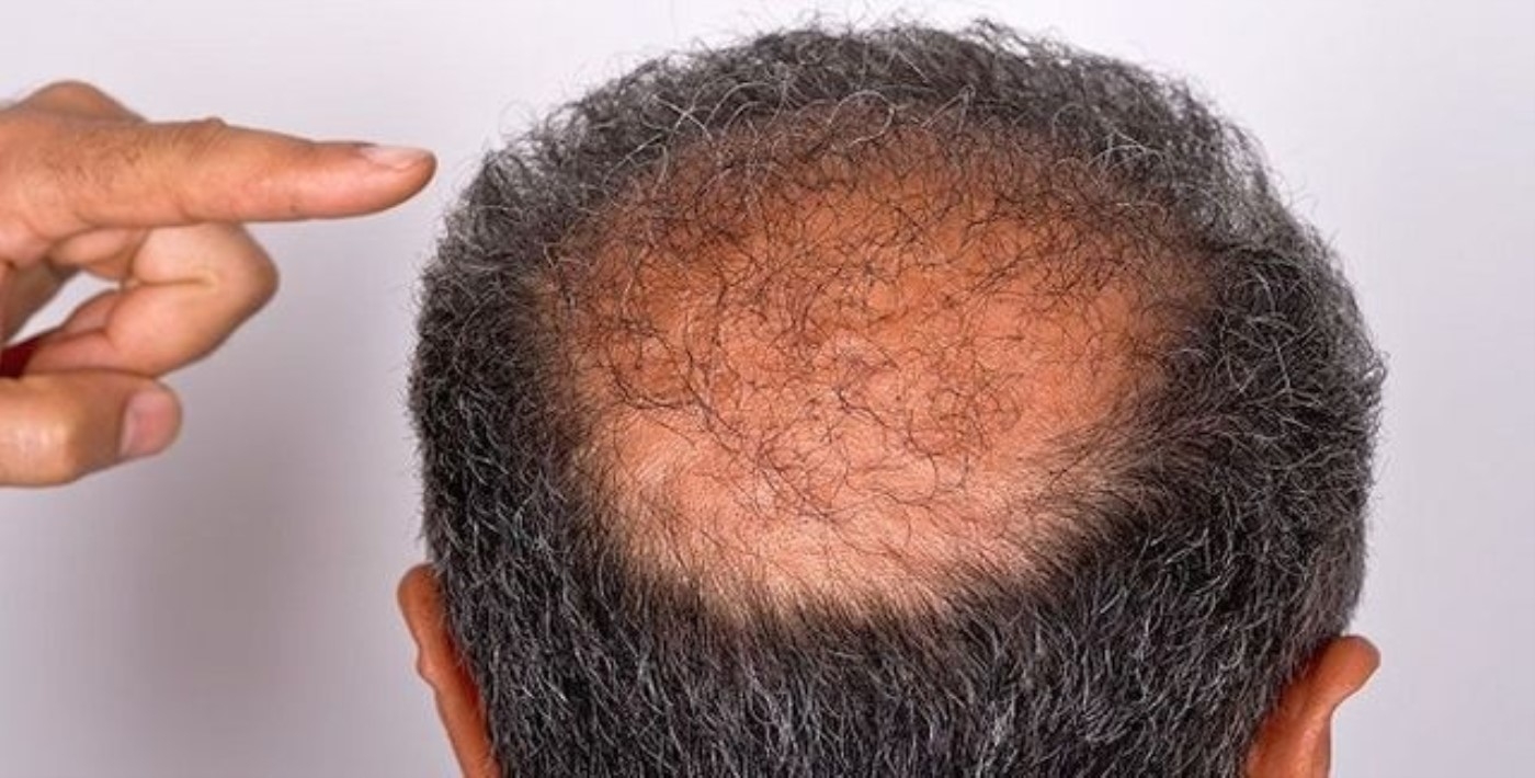 Rüyada Saç Yolmak / Rüyada Saçların Dökülmesi Tabiri