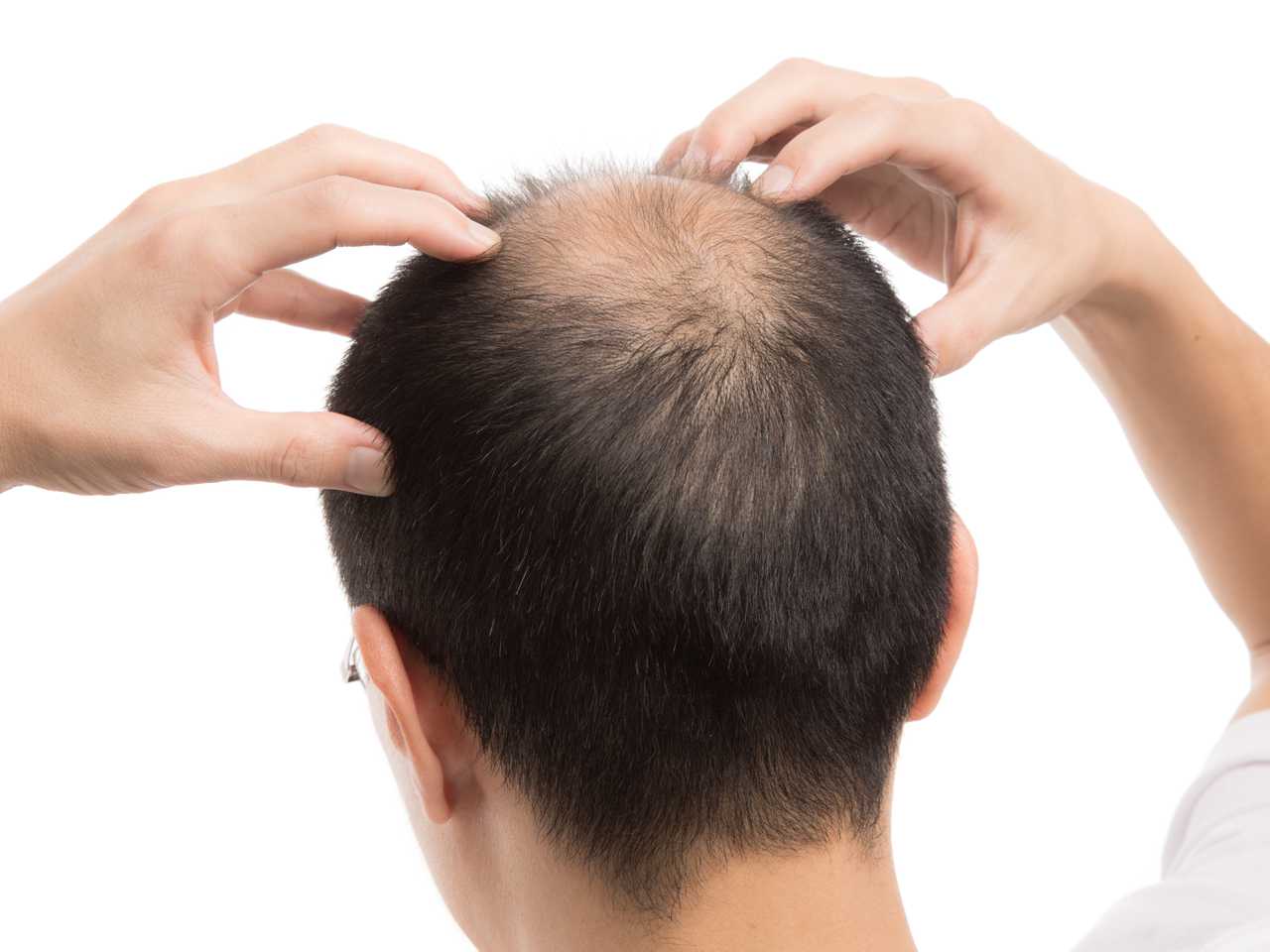 Rüyada Saçlarının Döküldüğünü Görmek Tabiri