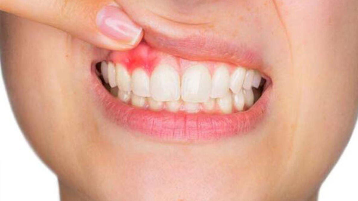 Rüyada Kanama Görmek / Rüyada Kanamak Tabiri