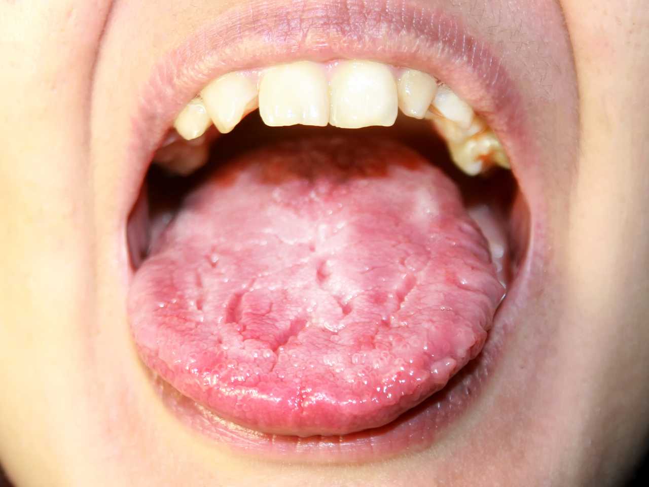 Ağız mantarı nedir? Neden olur? Bulaşıcı mıdır? | Ağız mantarı nasıl geçer?