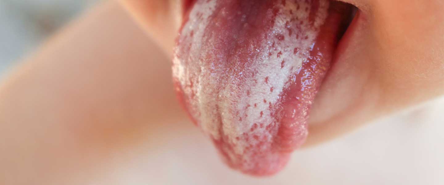 Ağız mantarı nedir? Neden olur? Bulaşıcı mıdır? | Ağız mantarı nasıl geçer?