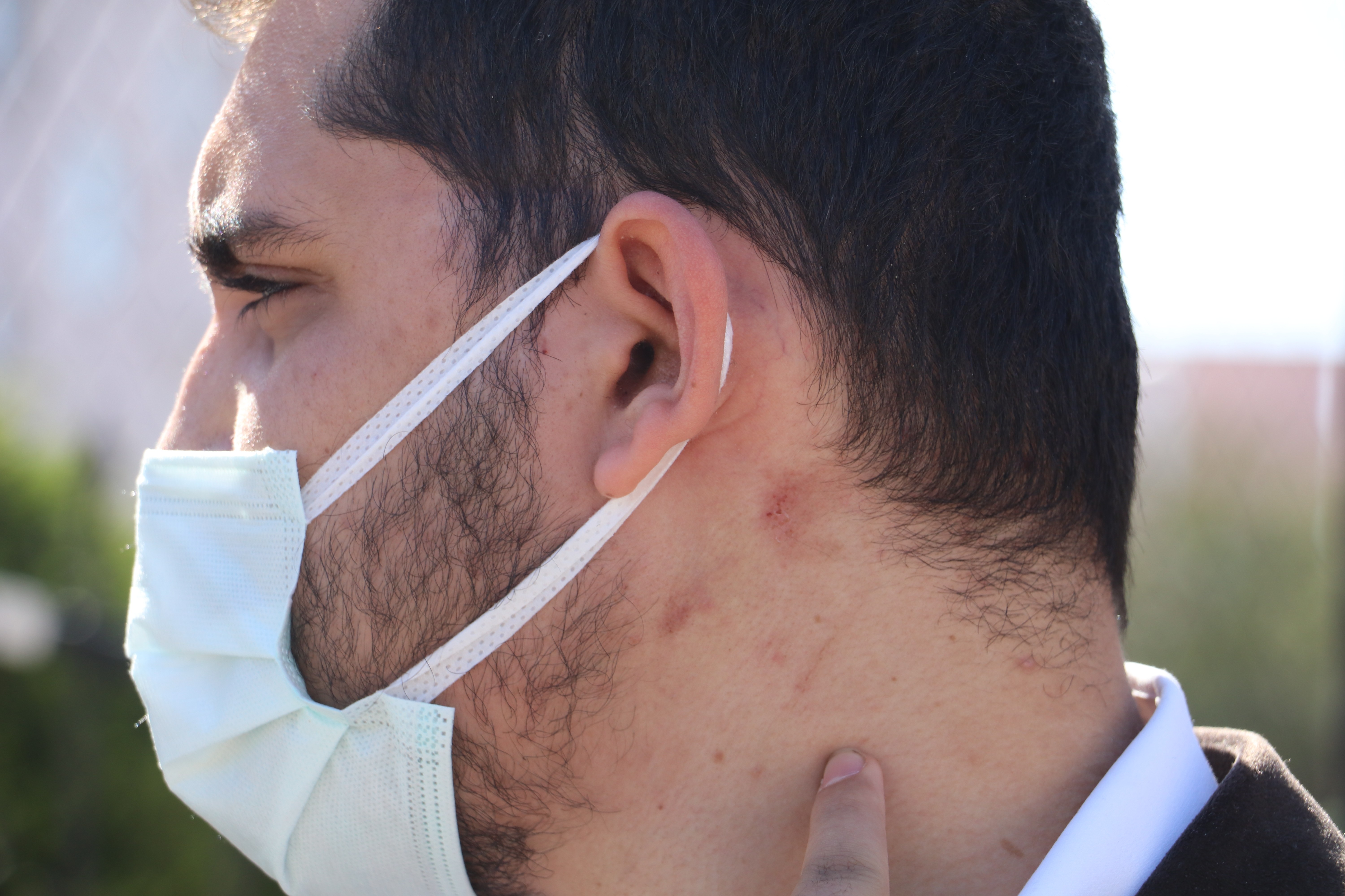 Antalya'da yüzde 90 engelli adamı öldüresiye darp ettiler