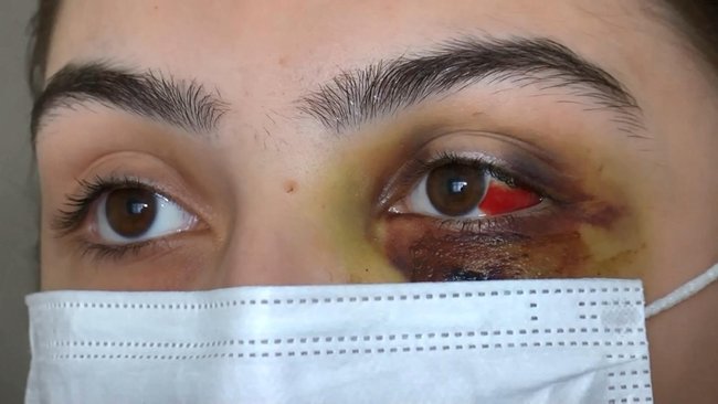 Genç kadın kocası tarafından yumruklu saldırıya uğradı