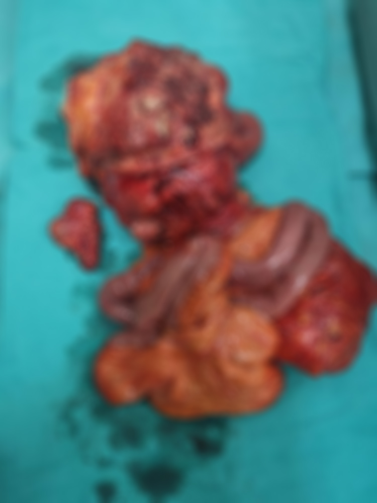 84 yaşındaki kadının karnından ameliyatla 20 santimetrelik tümör alındı