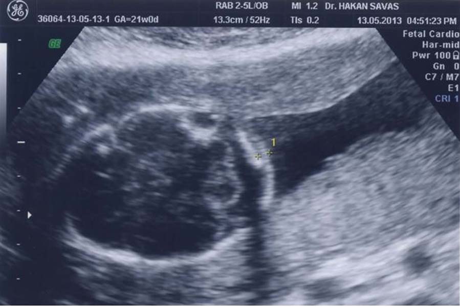 Down Sendromu Günü sözleri | Down Sendromu Günü mesajları