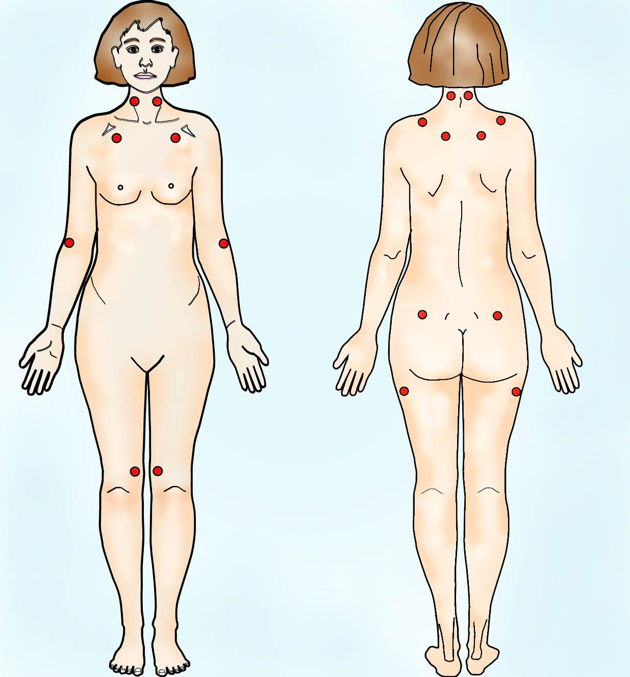 Fibromiyalji Belirtileri Nelerdir? Fibromiyalji Noktaları neresi?