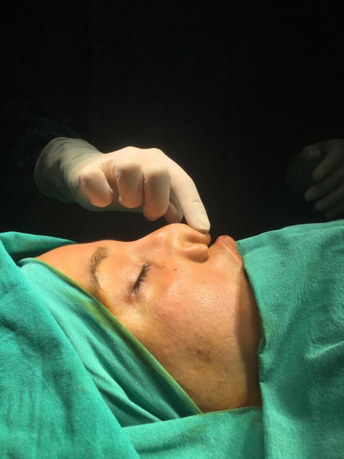 İlk kez gerçekleştirildi! Kaburga kıkırdağından yeni burun ucu