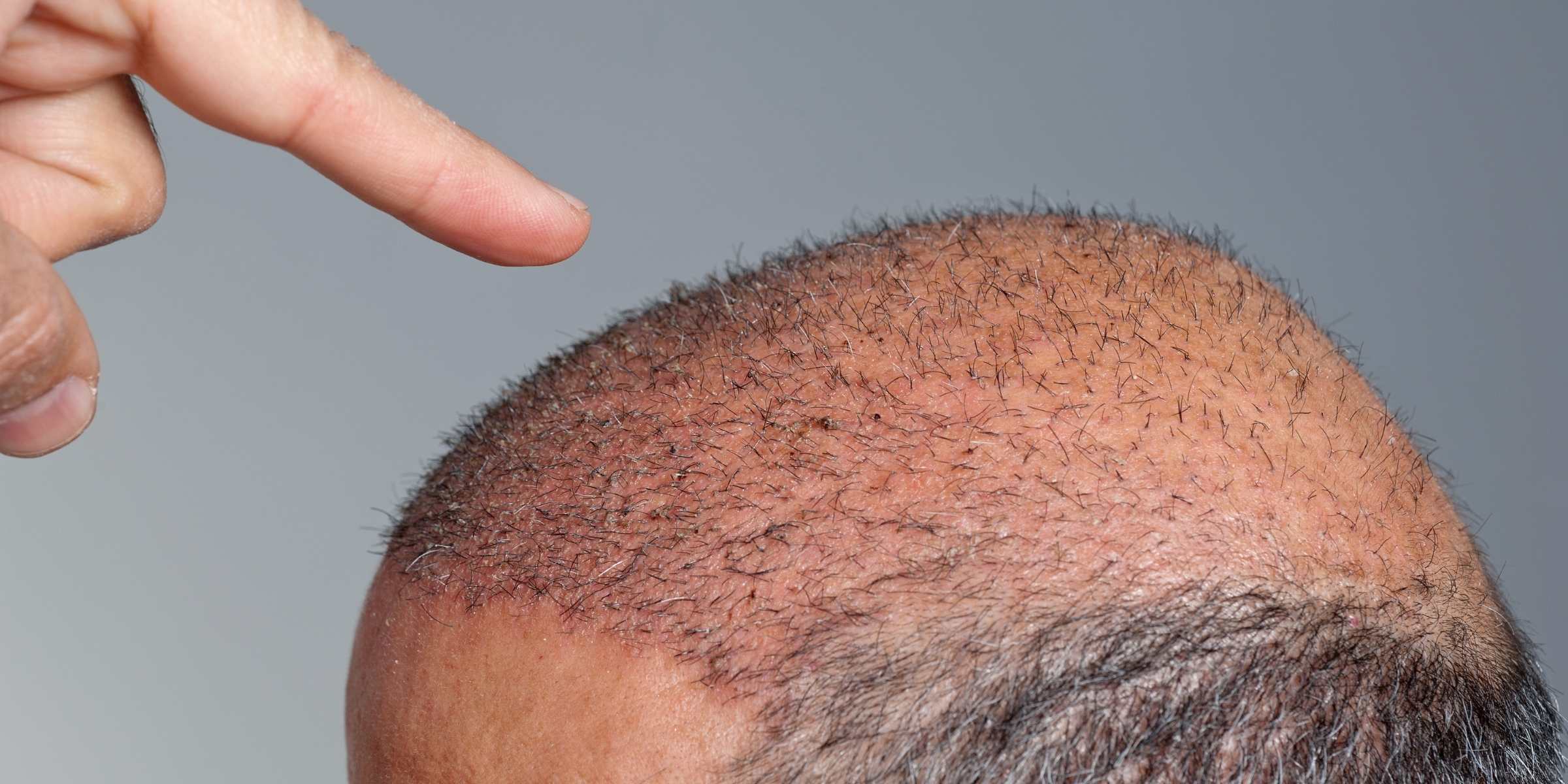 Saç ekimi nedir, fiyatları ne kadar? 2021 saç ekim ücretleri nedir?