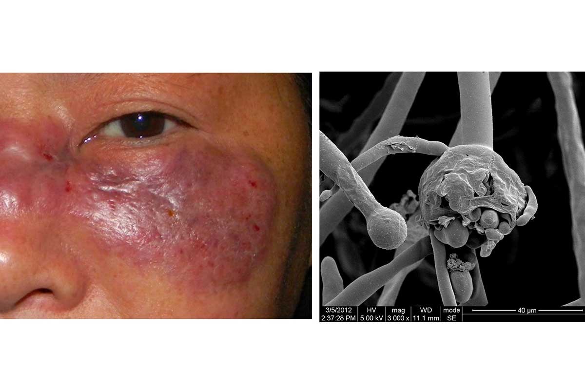 Hindistan'da yeni salgın Siyah Mantar: 219 kişi hayatını kaybetti, çok sayıda hastanın gözleri alındı!