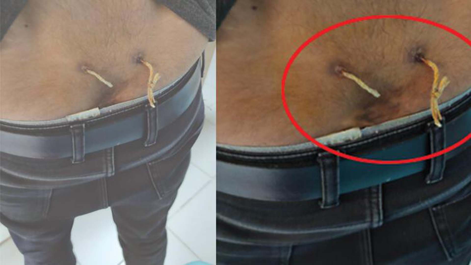 Elazığ'da akıl almaz tedavi yöntemi: Belinden iki delik açıldı, deri altından çamaşır ipi geçirildi