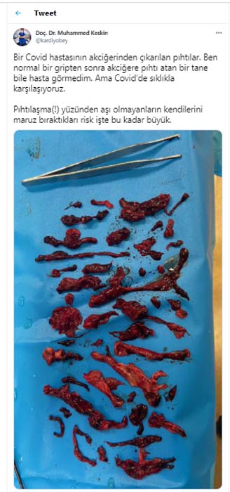 Dr. Muhammed Keskin paylaştı! Görenler dehşete düştü: İşte koronavirüs geçirdikten sonra akciğerden çıkanlar