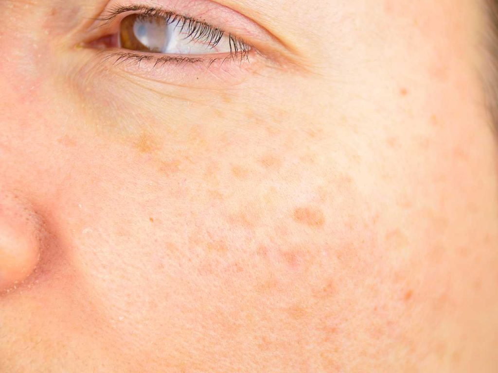 Hamilelikte güneş lekelerine dikkat! Anne adaylarının korkulu rüyası: Gebelik maskesi