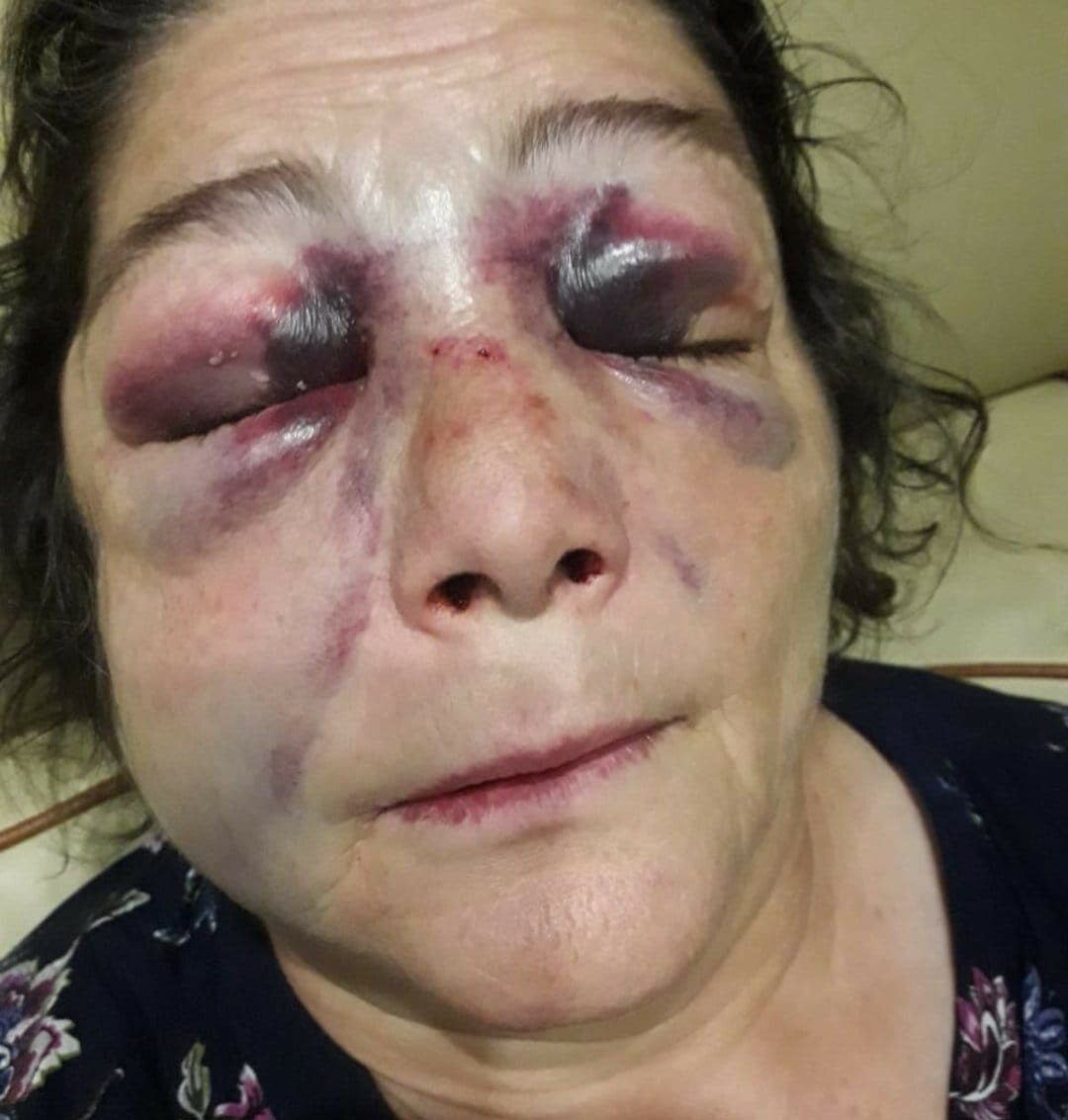 Öldüresiye darp edilen Ülfet Dikici olayında CHPli başkandan akıllara zarar savunma! Bana vurmaya çalışırken yüzünü masaya çarptı