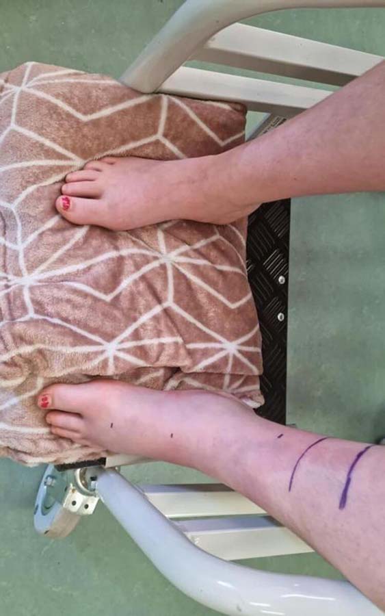 Engerek yılanının ısırdığı küçük kız ailesini inandıramayınca hastanelik oldu!