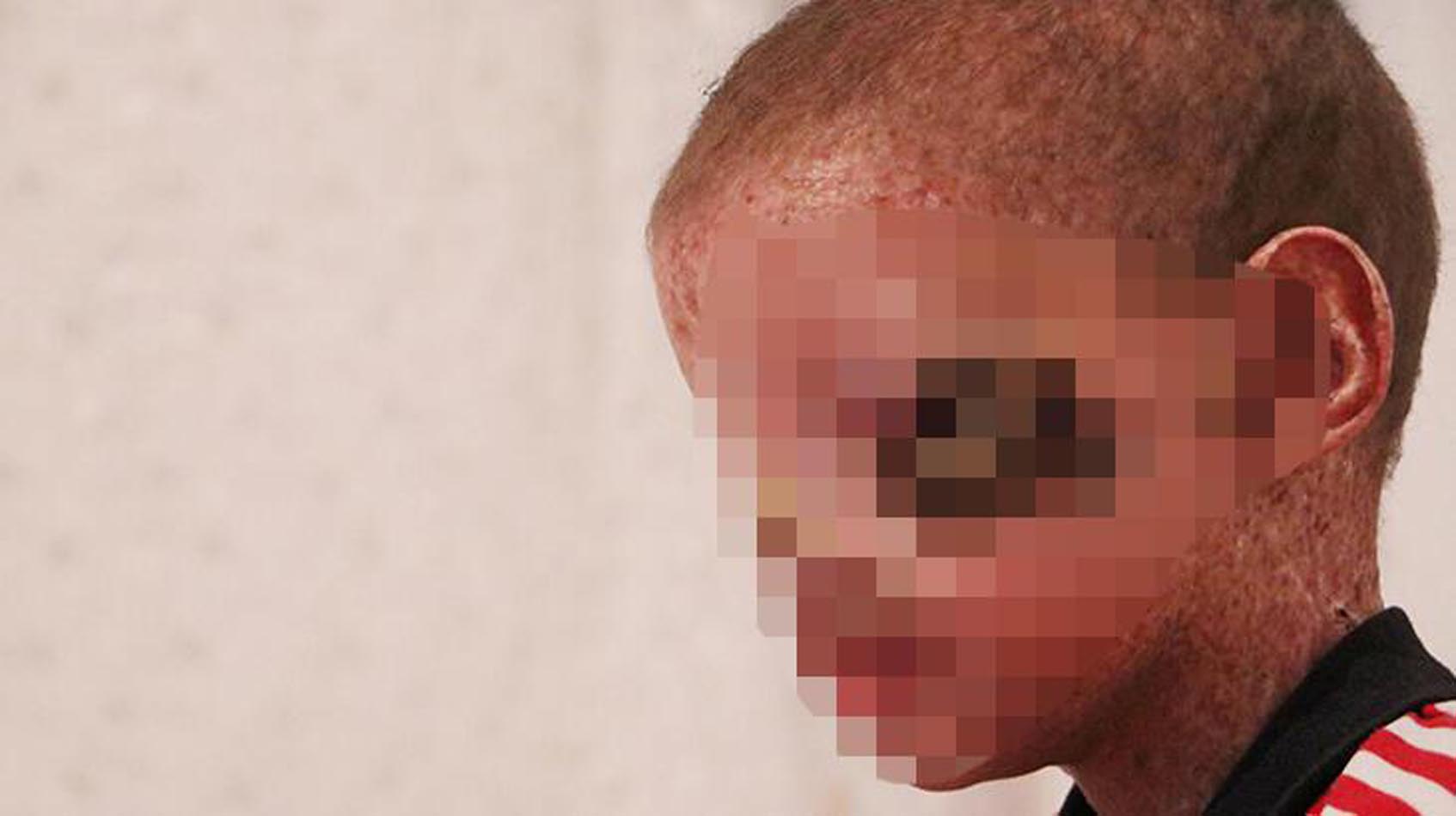 9 yaşındaki cilt kanseri Salih'ten sevindiren haber