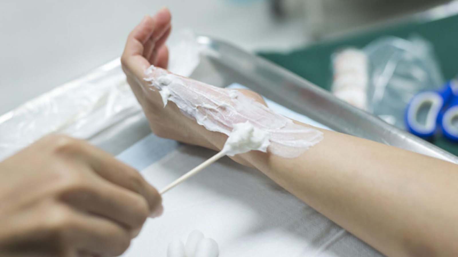 Uzman İsim yanığın üzerine asla sürmeyin dedi! Asla yapmayın! 