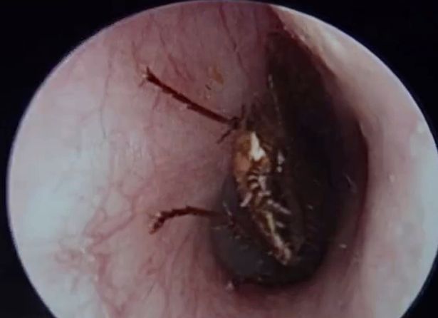 Akılalmaz olay! Küçük kızın kulağından 2 santimetre uzunluğunda hamamböceği çıktı