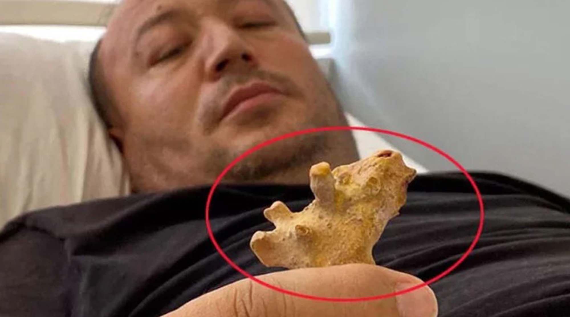 Doktorlar bile hayret etti! Böbreğinden geyik boynuzu çıktı!