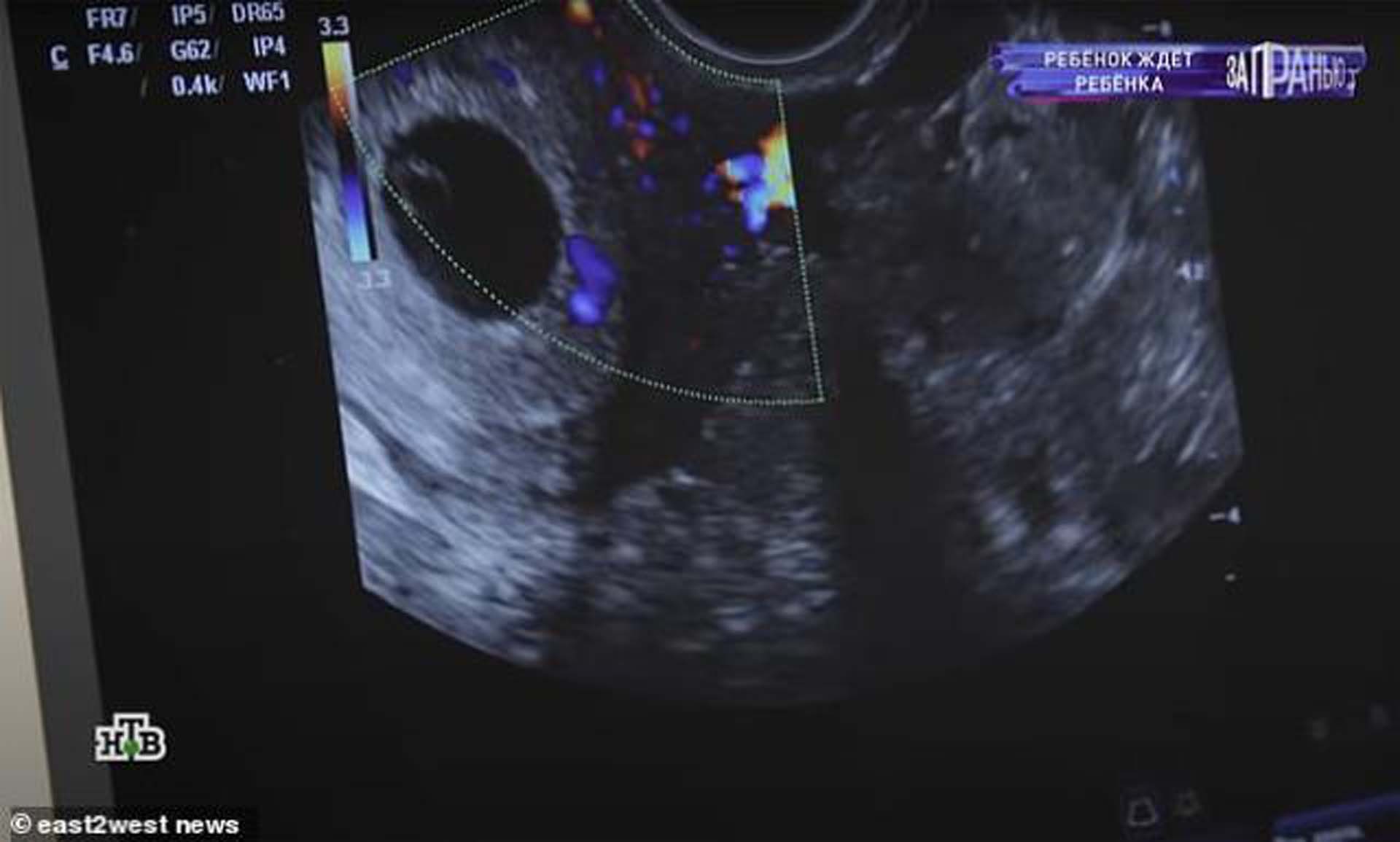 12 yaşındaki kızdan skandal olay! Sevgilisiyle cinsel ilişkiye girmek için yaşını büyük gösterip sevgilisinden hamile kaldı