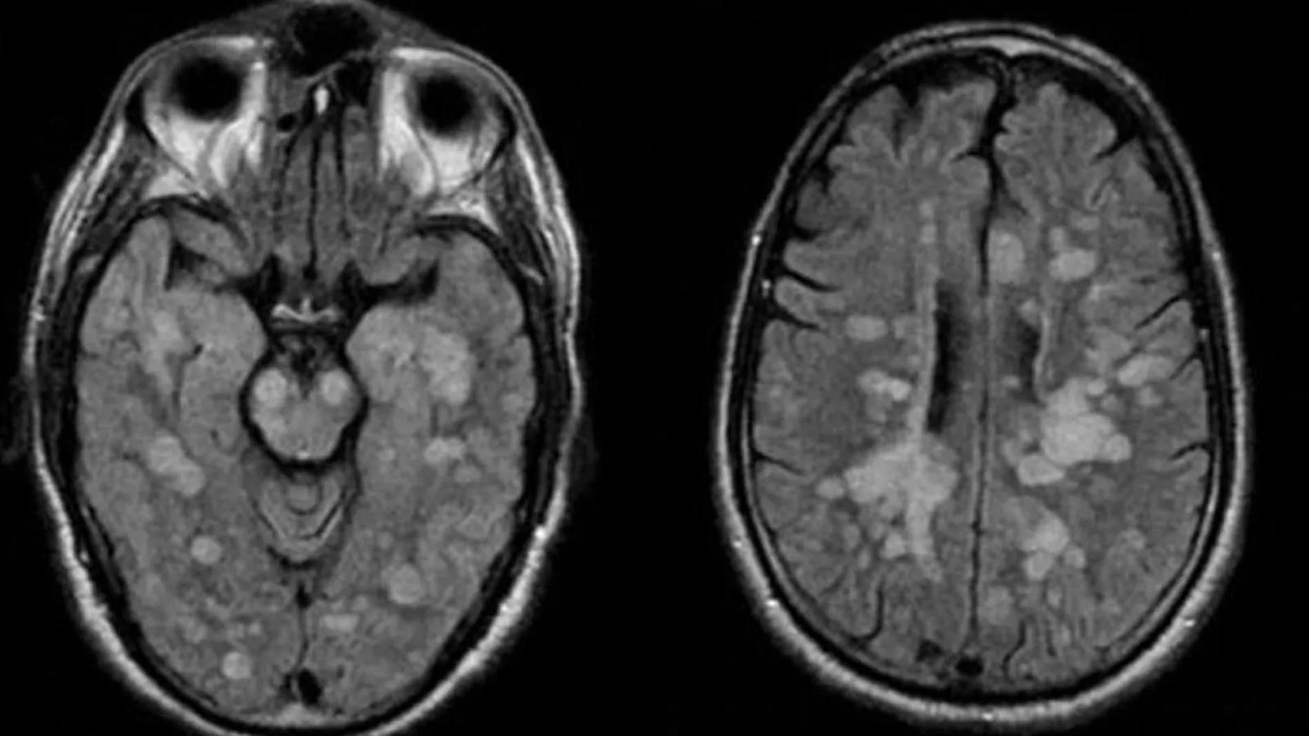 ABD'de yaşayan covid-19 hastası olan 8 yaşındaki çocuk felç oldu!