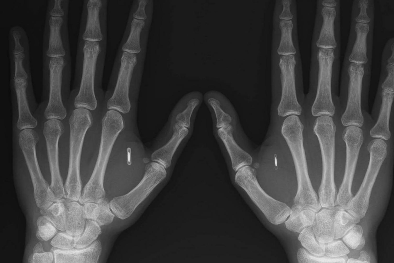 Aşı pasaportunu, ellerine mikroçip olarak taktırdılar! Anahtar ve kimlik taşımayı bıraktılar!