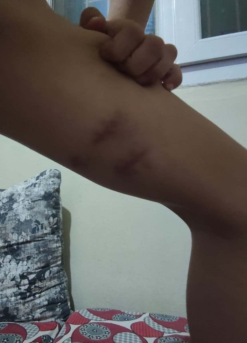 İzmir Buca'da pitbull dehşeti! Saldırıya uğrayan çocuğun psikolojisi bozuldu, sokağa dahi çıkamıyor!