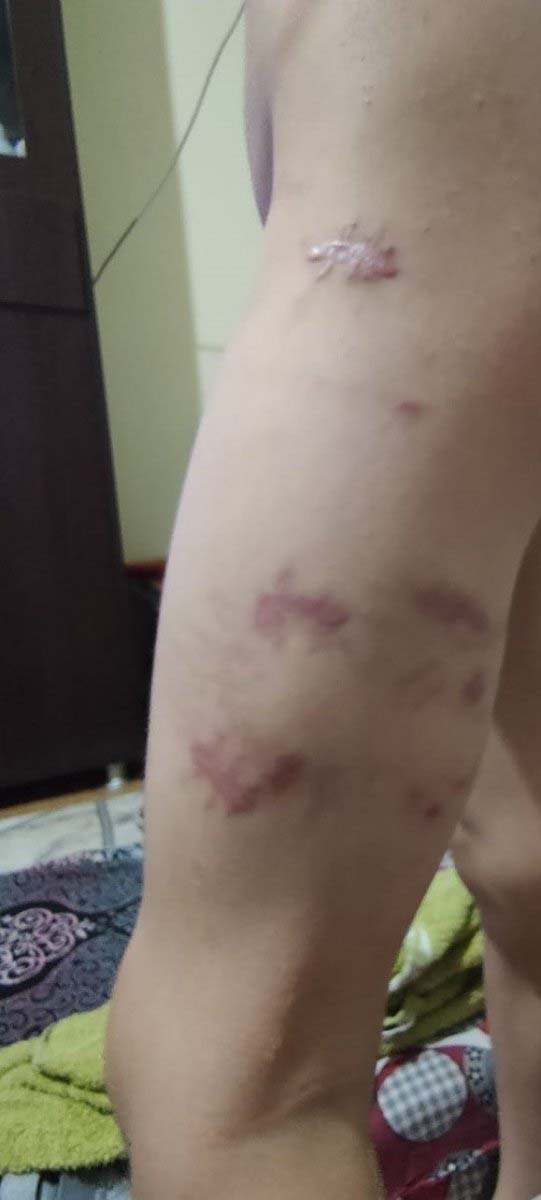 İzmir Buca'da pitbull dehşeti! Saldırıya uğrayan çocuğun psikolojisi bozuldu, sokağa dahi çıkamıyor!