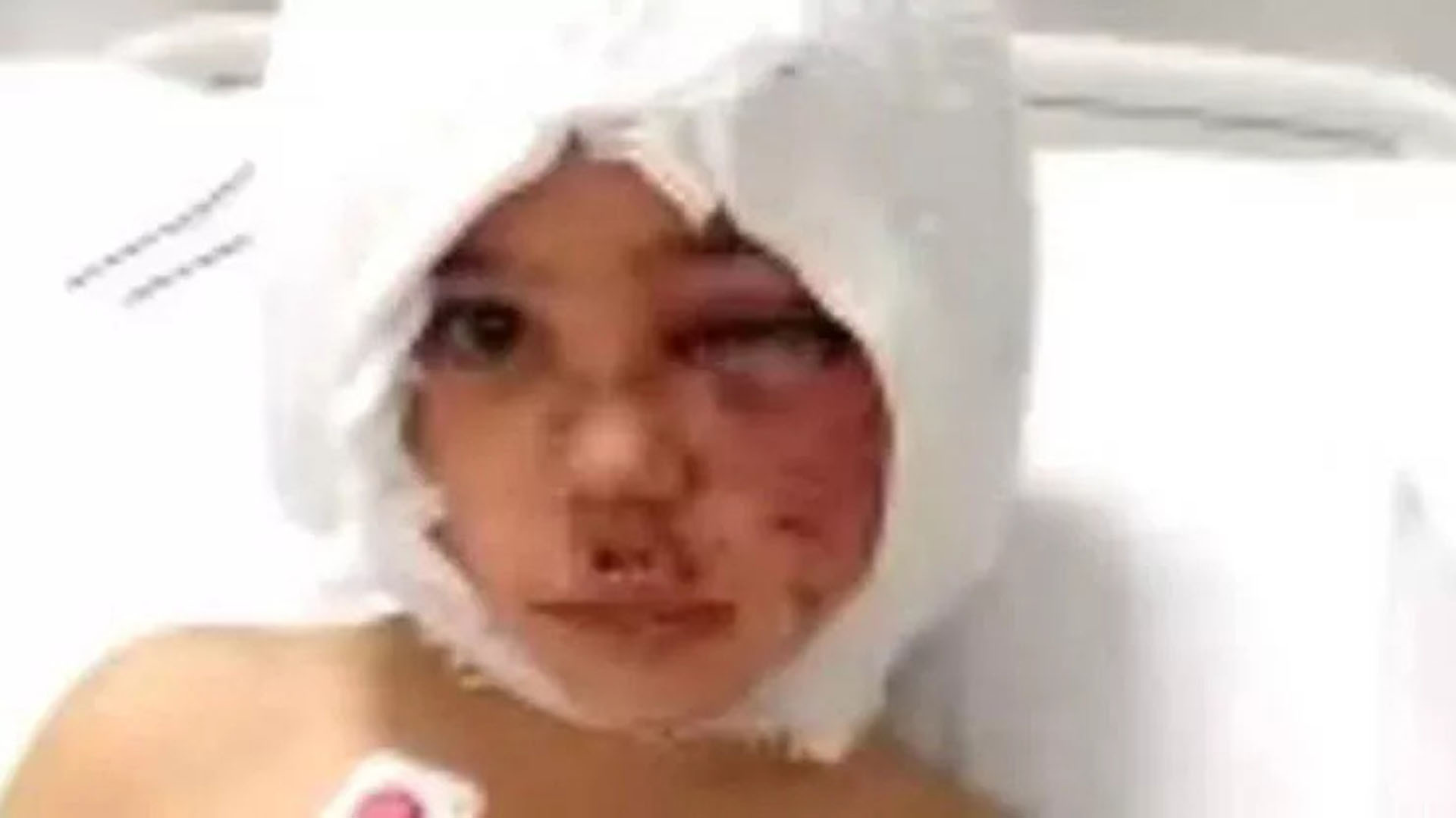 Pitbull saldırısına uğrayan minik Asiye'nin sağlık durumu belli oldu! Doktoru son durumunu açıkladı!