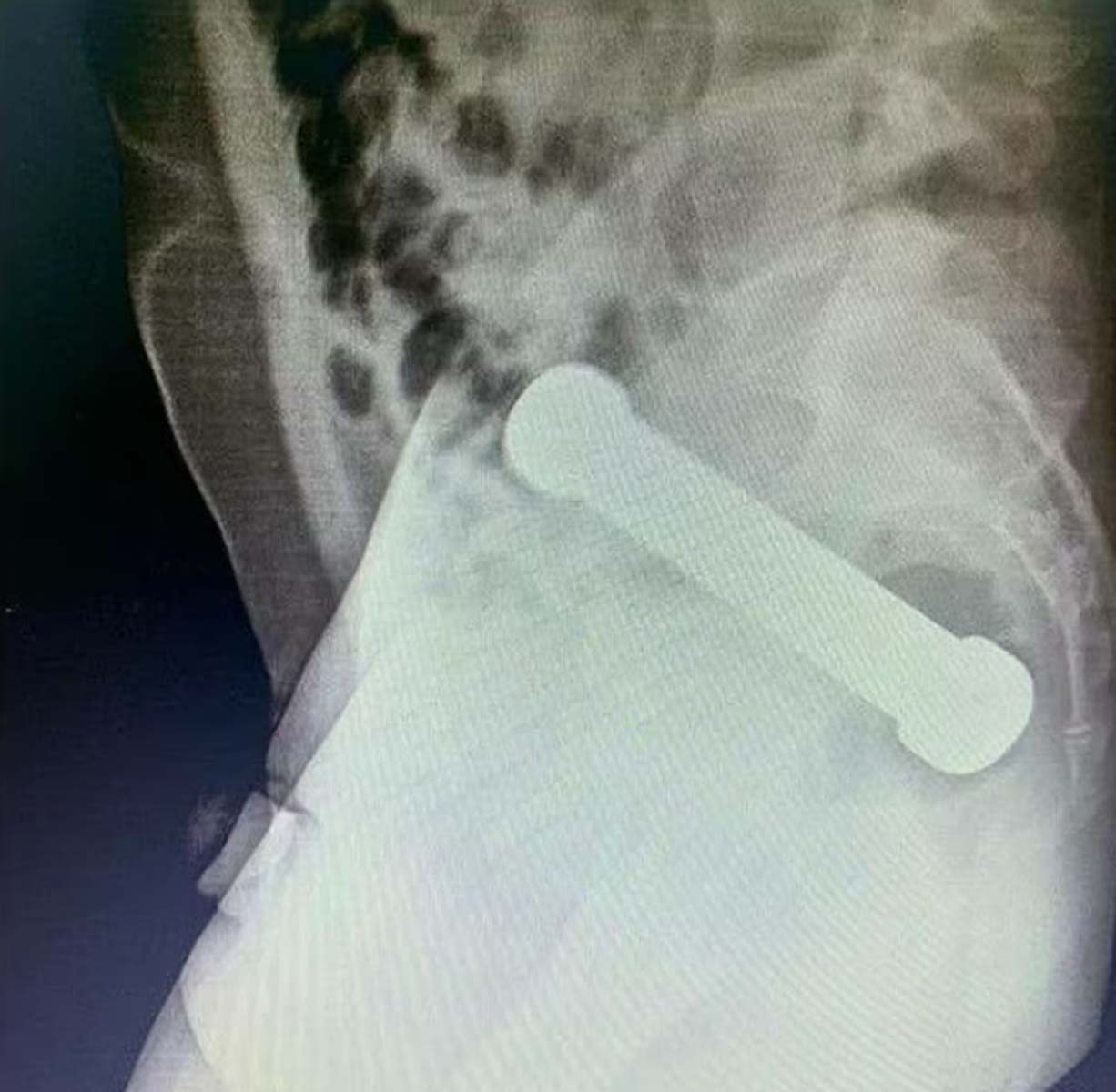 Röntgene bakan doktorlar gördüklerine inanamadı! 54 yaşındaki adam makatına 2 kg ağırlığında 20 cm dambıl soktu 