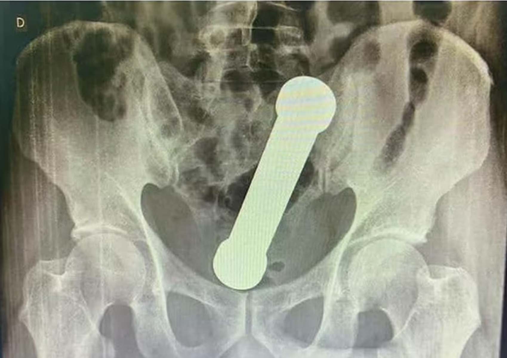 Röntgene bakan doktorlar gördüklerine inanamadı! 54 yaşındaki adam makatına 2 kg ağırlığında 20 cm dambıl soktu 