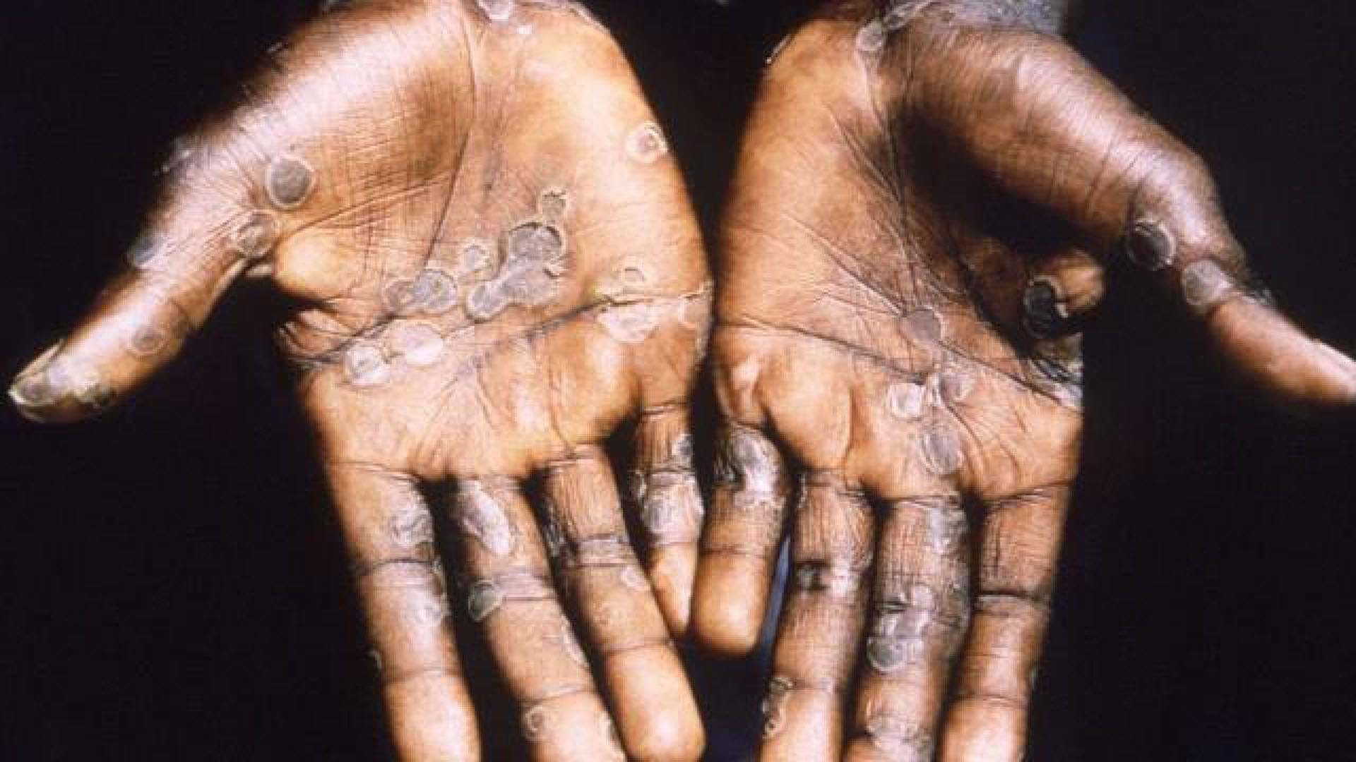 Maymun çiçeği virüsü Türkiye'de var mı, görüldü mü? Kaç vaka var?