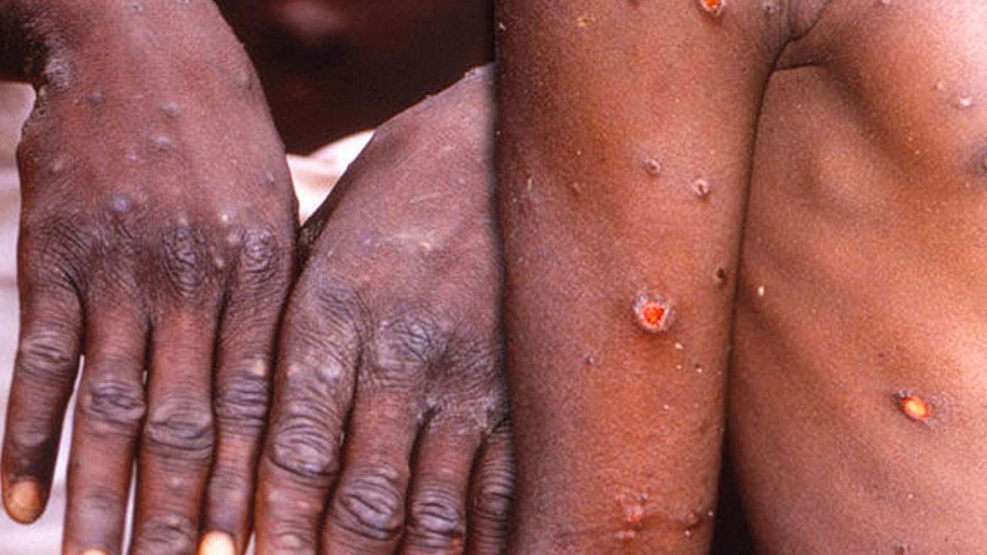 Son dakika! Bakan Koca felaketi duyurdu! Türkiye'de ilk maymun çiçeği vakası tespit edildi!