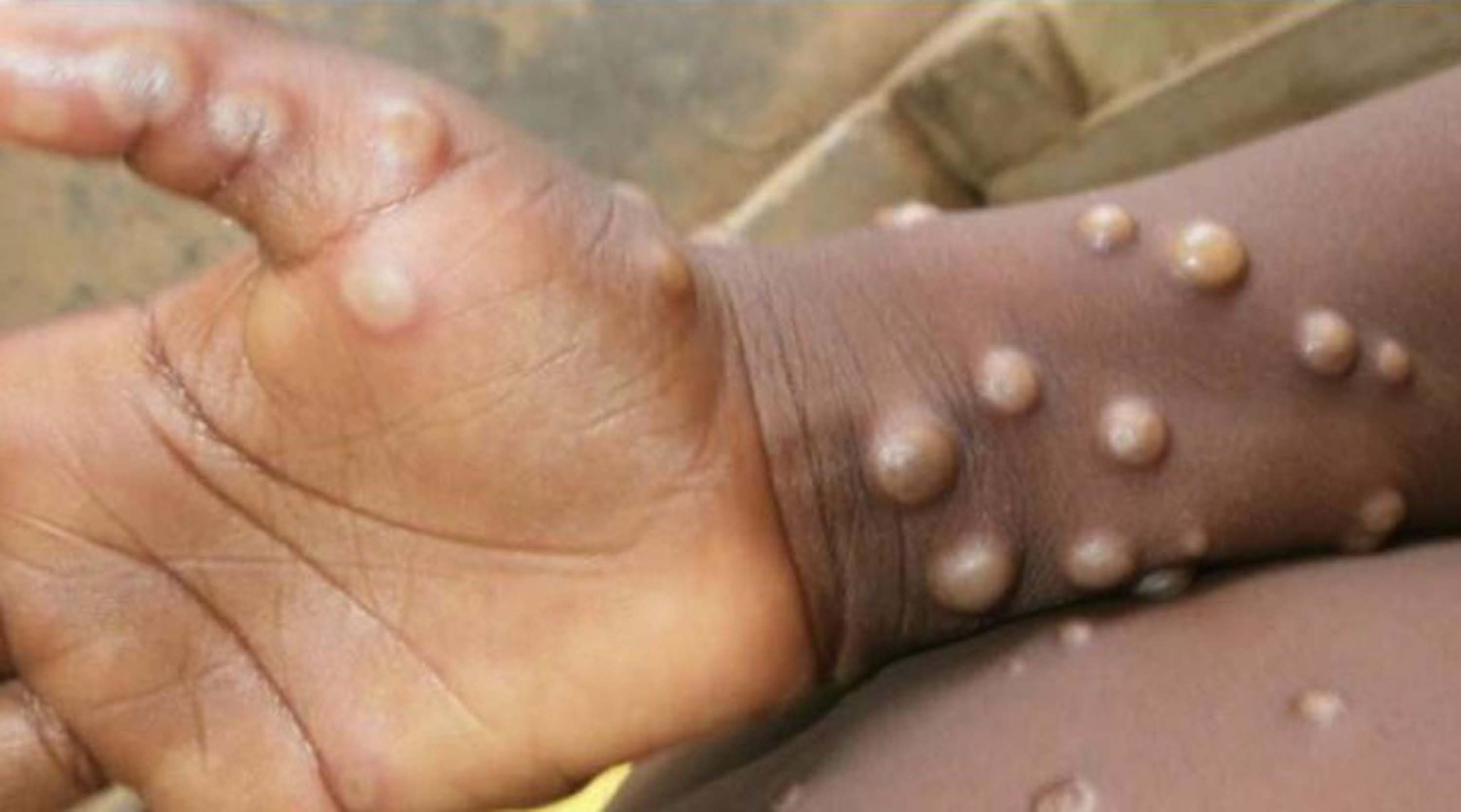 Son dakika! Bakan Koca felaketi duyurdu! Türkiye'de ilk maymun çiçeği vakası tespit edildi!