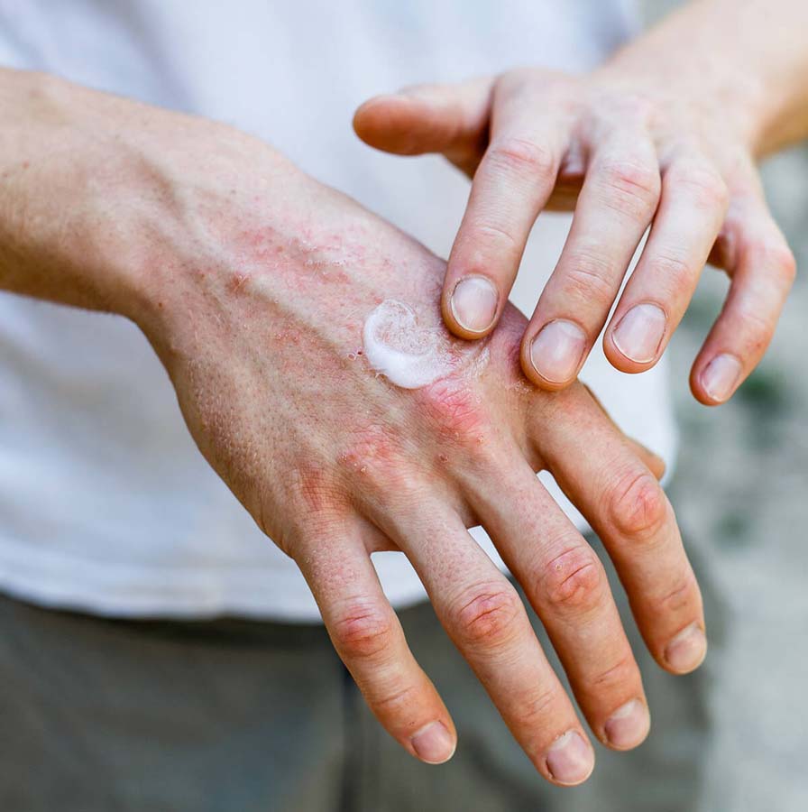  Dermatoloji Uzmanı Doç. Dr. Özlem Ekiz'den yaz aylarında artan incir egzaması uyarısı! Hastalar, incirin egzama yapabileceği konusunda uyarılmalı