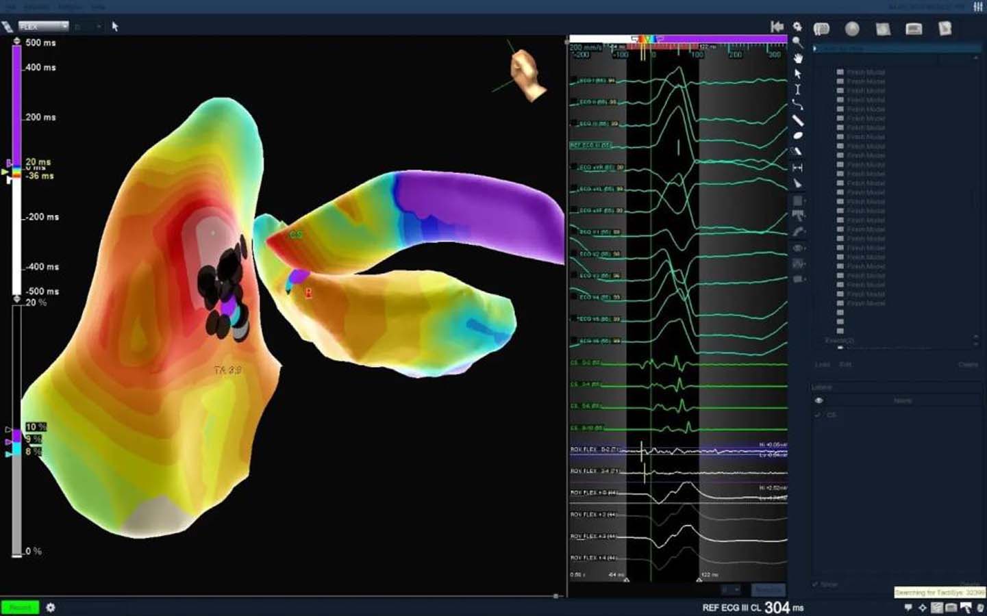 Yıllardır çektiği kalp yetmezliği ritim bozukluğuna neden olmuştu! 3 boyutlu ablasyon yöntem ile sağlığına kavuştu!