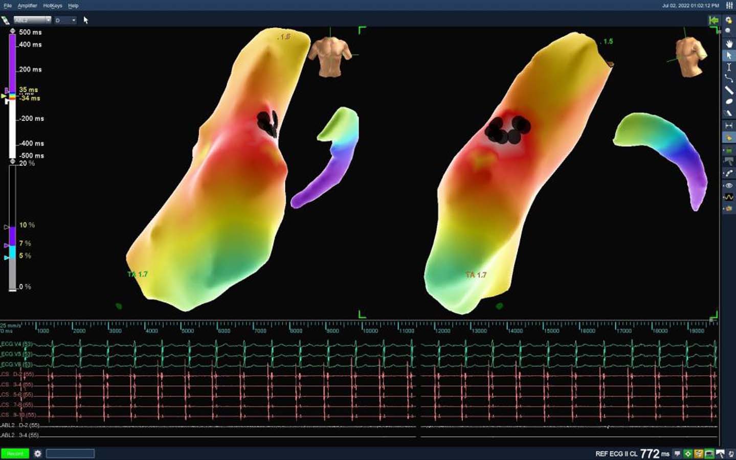 Yıllardır çektiği kalp yetmezliği ritim bozukluğuna neden olmuştu! 3 boyutlu ablasyon yöntem ile sağlığına kavuştu!