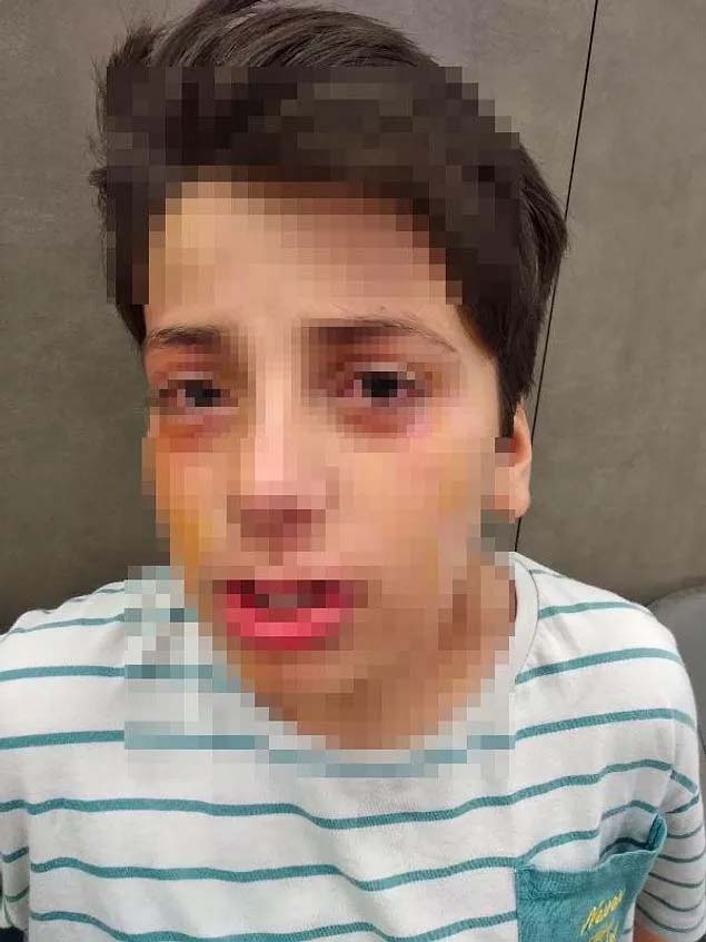 Ses bombası yapayım derken kör oluyordu! 11 yaşındaki çocuk, hazırladığı karışım patlayınca gözlerinden yaralandı!