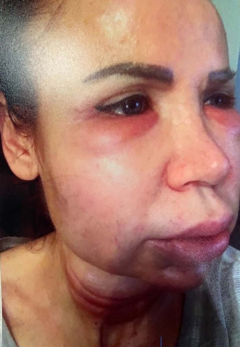 Estetisyen diplomasız çıktı! Dolgu yaptırmak isteyen kadın, sahte doktor yüzünden bambaşka biri oldu!